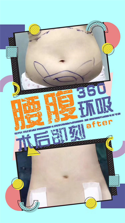 西安腰部抽脂整形 