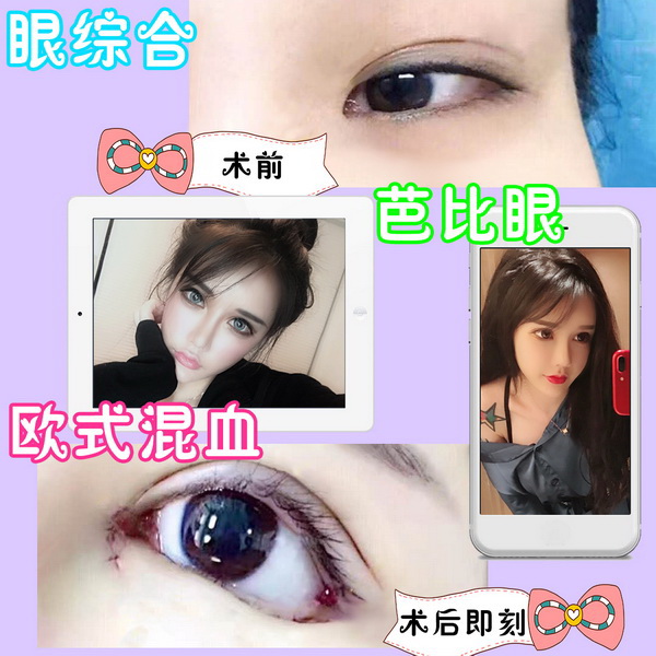 西安欧式混血眼综合 