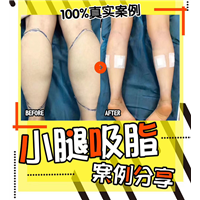 西安小腿抽脂术 