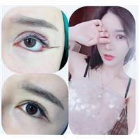 西安眼部整形修复 
