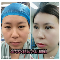 西安全切双眼皮整形 