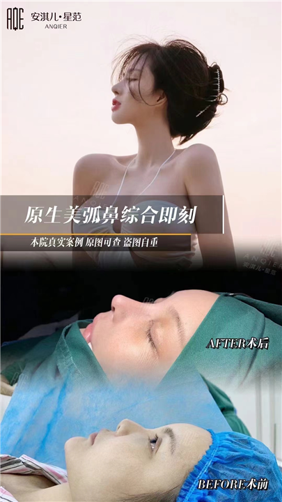 安淇儿原生美弧鼻综合整形