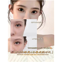 安淇儿星范贴面耳矫正+卧蚕成型