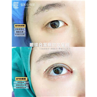 安淇儿·星范眼综合整形