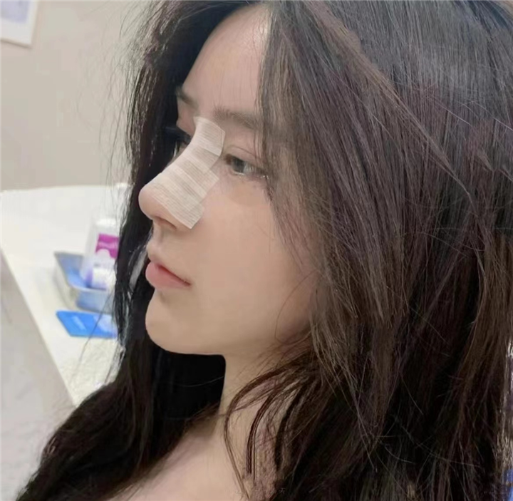 上海安禾美阁肋骨鼻整形