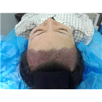 上海植发刘野院长fue微针技术