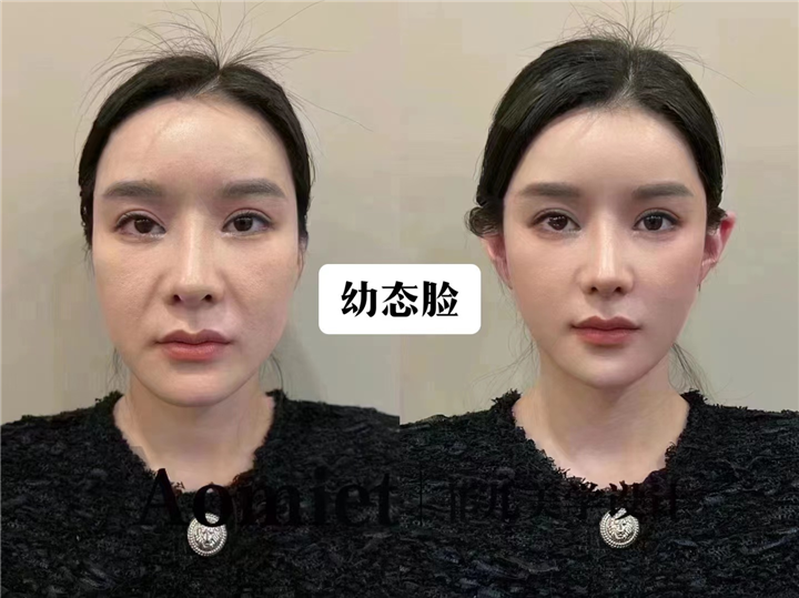 上海安禾美阁幼态脸打造