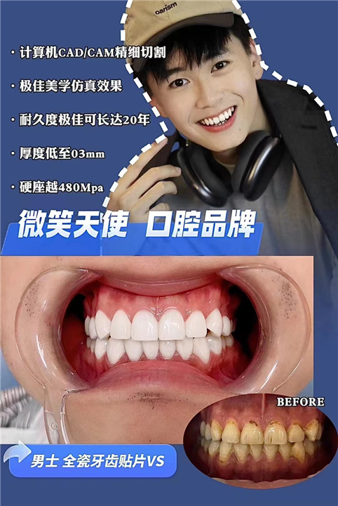 上海美牙,男士全瓷牙齿贴片
