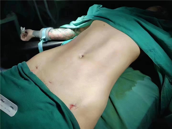 上海安禾美阁腰腹吸脂马甲线折角腰打造