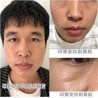 印第安纹苹果肌剥离后