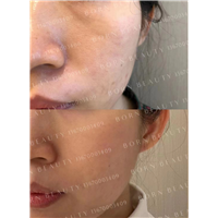 印第安纹如何解决？如何选择性价比高的医美机构？