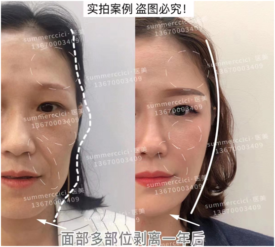 印第安纹剥离效果怎么样？会让人有疼痛感吗？