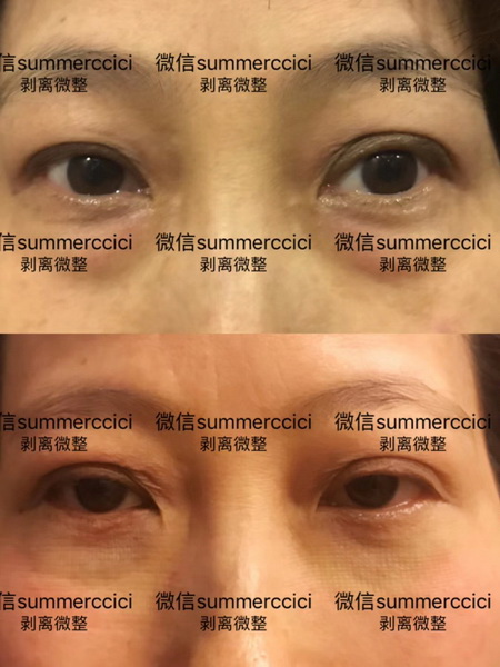 剥离祛眼袋