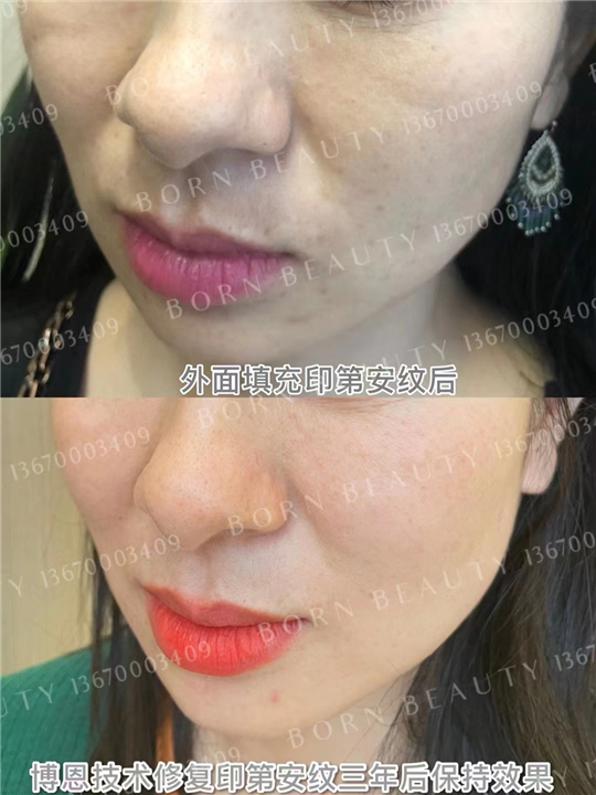 印第安纹有哪些类型？不同类型的印第安纹使用什么方法处理呢？