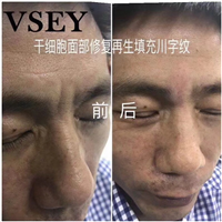 无针医美是什么|VSEY无针微整形培训