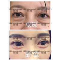 眼袋卧蚕剥离