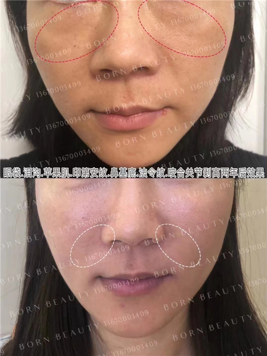 哪种医美技术能够有效去除印第安纹？副作用小的技术是什么？