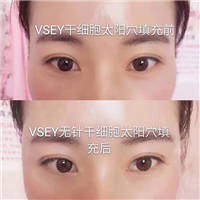 无针医美|无针医美是什么