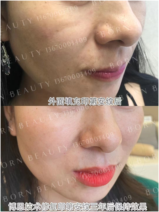 什么是印第安纹？其形成的原因和消除方式有哪些？
