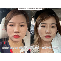 印第安纹怎么才能消除？哪种方法更有效？