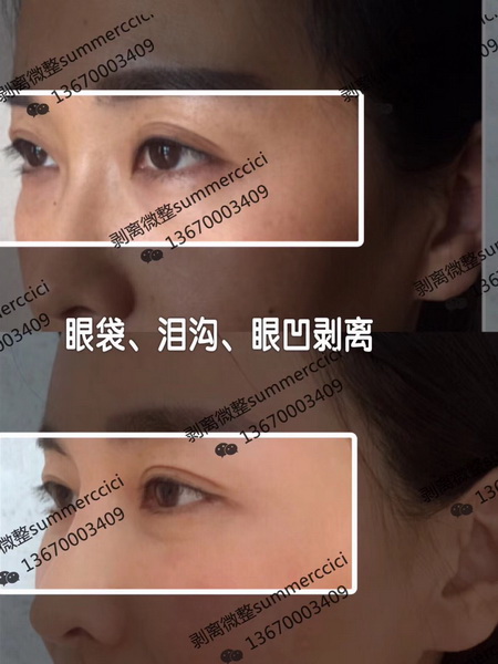 眼袋泪沟眼凹剥离