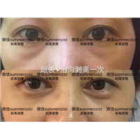 眼袋泪沟剥离一次