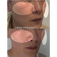 印第安纹苹果肌剥离两次七个月后