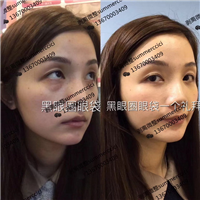 黑眼圈眼袋一个礼拜