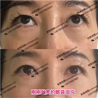刚刚做完的眼袋泪沟