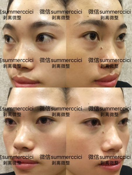 眼袋泪沟剥离