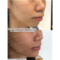 印第安纹填充和印第安纹剥离，哪个效果好？