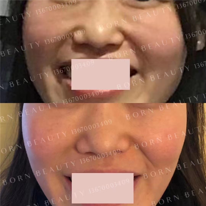 印第安纹如何解决？哪种印第安纹去除方法更有效？