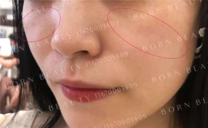 空塌型印第安纹带来的憔悴感，看专业团队如何解决？