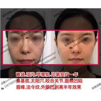 眼袋泪沟苹果肌印第安纹剥离一年
