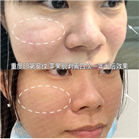 重度印第安纹苹果肌剥离四次一年半后效果