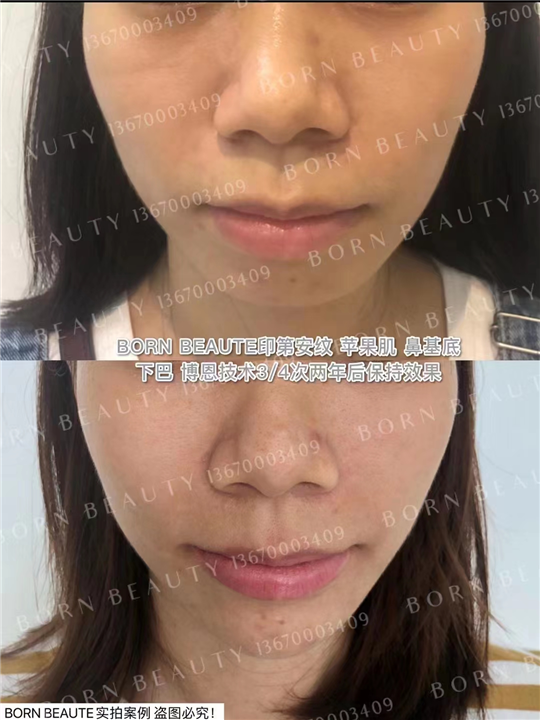 印第安纹怎么改善好？印第安纹剥离手术安全吗？