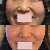 印第安纹如何解决？哪种印第安纹去除方法更有效？