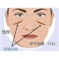 为什么填完苹果肌印第安纹会加深？居然和这3点有关