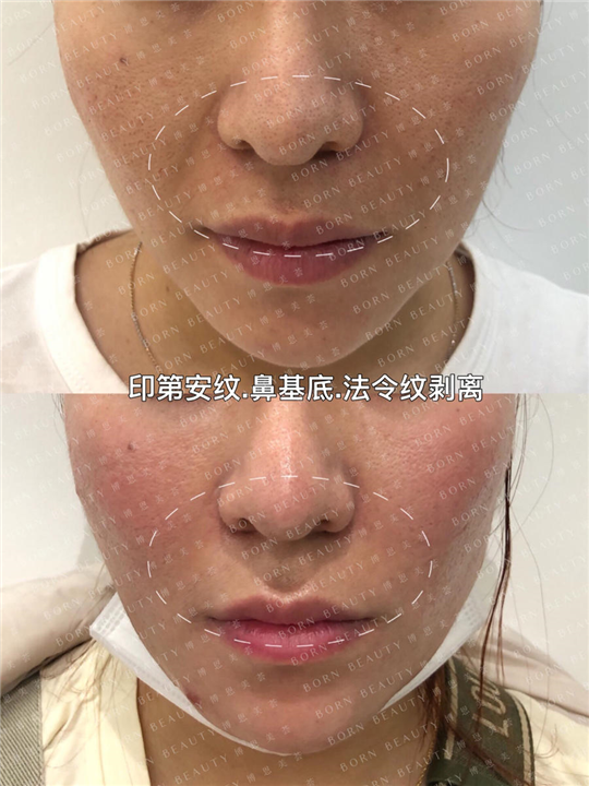 印第安纹鼻基底法令纹剥离