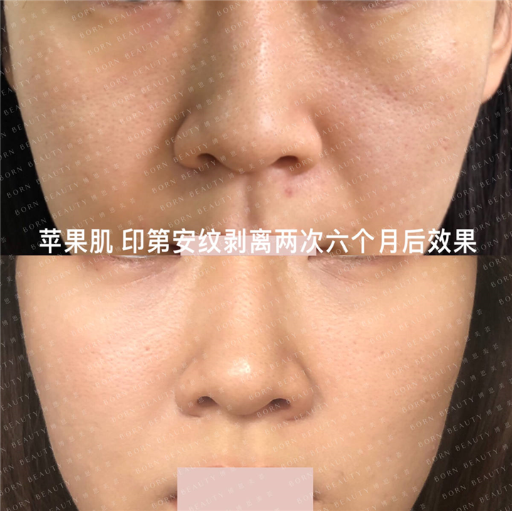 苹果肌印第安纹剥离两次六个月后效果