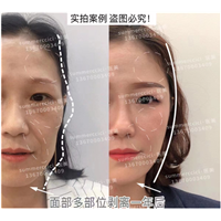 印第安纹剥离效果怎么样？会让人有疼痛感吗？