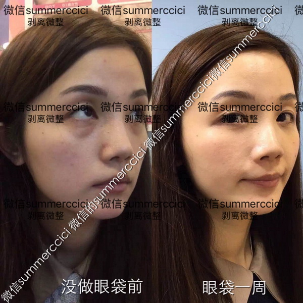 剥离眼袋一周