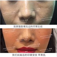 印第安纹怎么去除效果好？