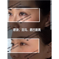眼袋泪沟眼凹剥离