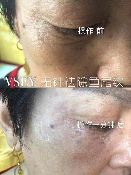 无针医美是什么|VSEY无针微整形培训