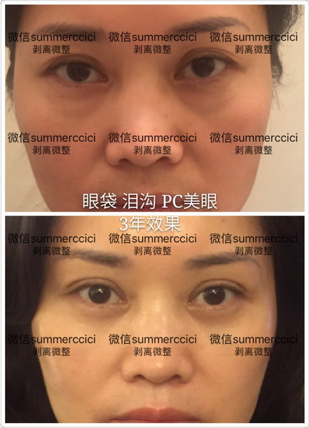 眼袋泪沟pc美眼