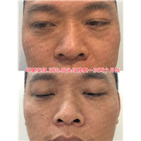 印第安纹泪沟抬头纹修复一次两个月后