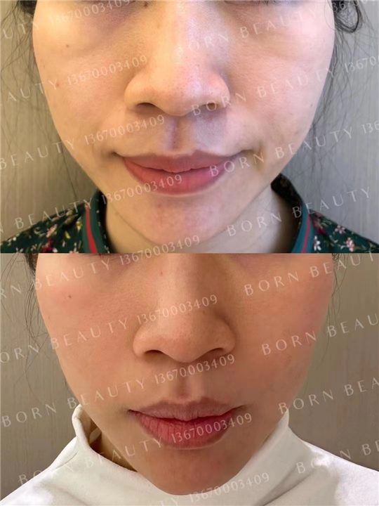 印第安纹会自己消退吗？如何正确对抗印第安纹的生长？