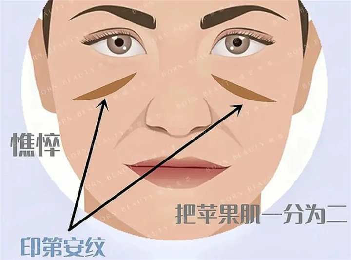 为什么填完苹果肌印第安纹会加深？居然和这3点有关