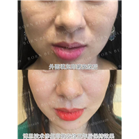 为什么会出现印第安纹？形成原因有哪些？